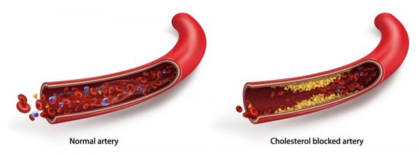 Normal Artery vs Atheroclerosis