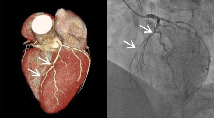 Coronary artery disease imaging 3