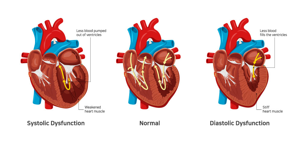 Systolic, Normal and Diastolic Function
