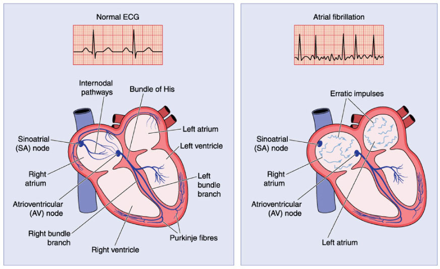 Normal ECG and Atrial Fibrilation illustration
