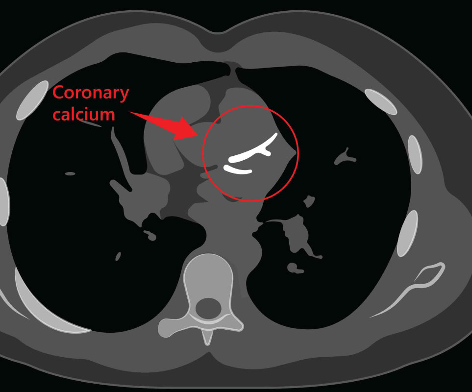 Coronary Calcium Scan