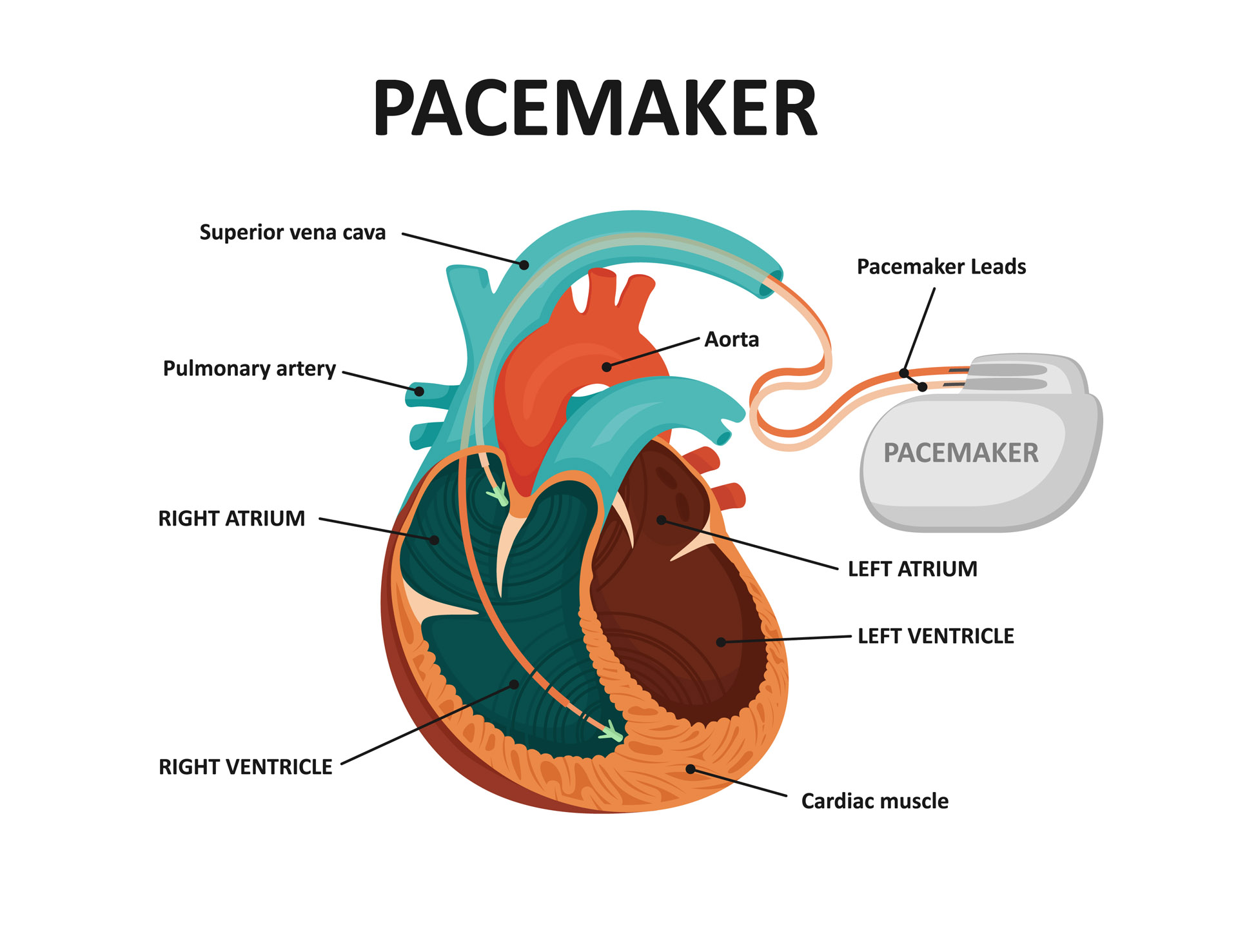 Pulse Generator Of A Pacemaker At Tyler Aikenhead Blog Pulse Generator Of A Pacemaker At Tyler Aikenhead Blog