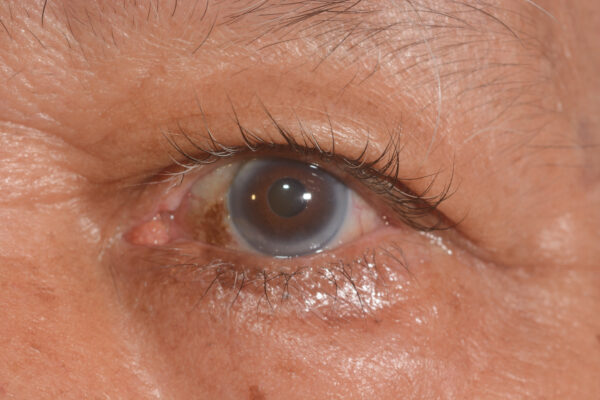 Close,Up,Of,Arcus,Senils,During,Eye,Examination